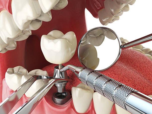 Best Emergency Dentist for Lost Fillings or Crowns in Oceano, CA
